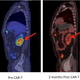 Before and after image shows lymphoma regression after CAR T-cell therapy. Credit: Fred Hutch News Service